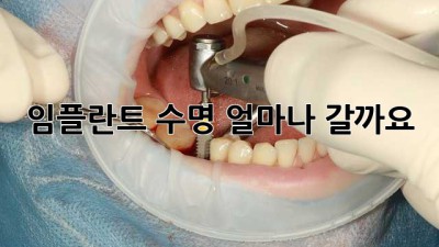 임플란트 수명, 얼마나 갈까요?